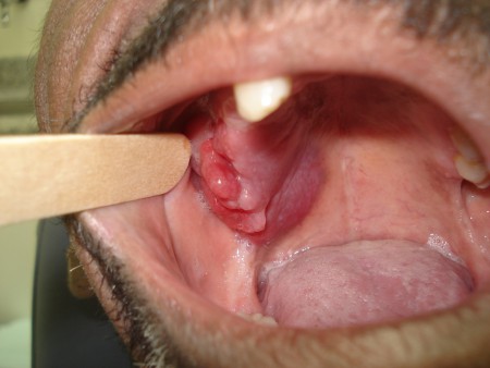sarcoma de Kaposi (HIV)